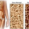    No dia 20 de outubro comemora-se o dia Mundial da Prevenção e Combate à Osteoporose. E para alertar a população sobre a gravidade da doença a Unidens Densitometria Óssea, através de sua administradora, Dra. Maria Lúcia A. de Azevedo […]